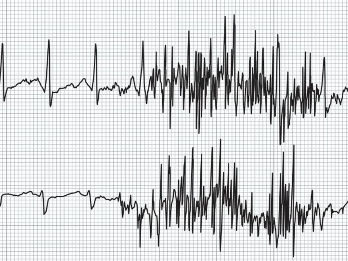 A Guide to ECG Signal Filtering GE HealthCare (United Kingdom)